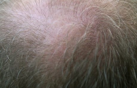 השתלת שיער – כל הטיפים