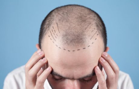 השתלת שיער – שיטת DHI: סקירת היתרונות