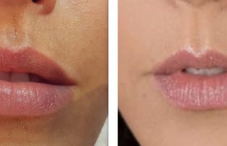 חברת "מד אופ אסתטיק" משדרגת את טיפול התפחת השפתיים