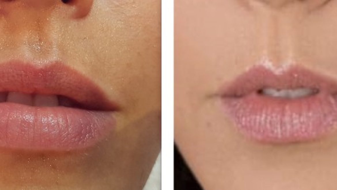 חברת "מד אופ אסתטיק" משדרגת את טיפול התפחת השפתיים