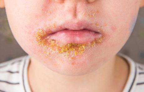 זהירות ! אימפטיגו – מחלת העור המדבקת בקרב ילדים
